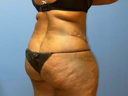 Liposuction Before & After