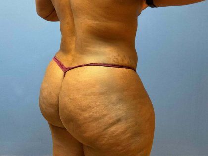 Liposuction Before & After