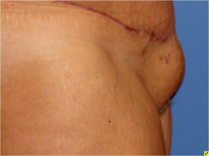 Liposuction Before & After