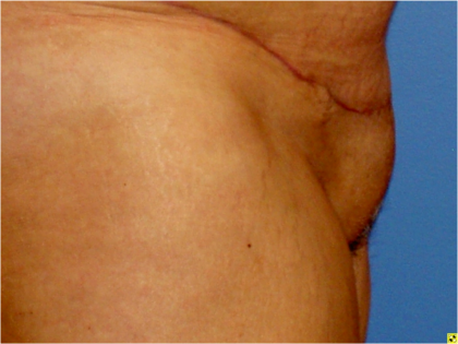 Liposuction Before & After