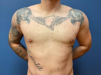 Liposuction Before & After