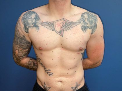 Liposuction Before & After