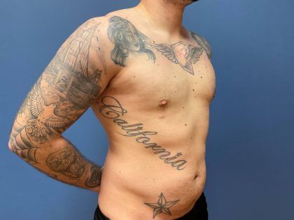 Liposuction Before & After