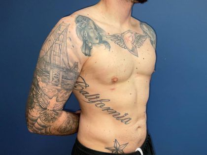 Liposuction Before & After