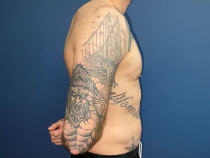 Liposuction Before & After