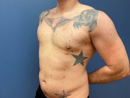 Liposuction Before & After