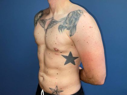 Liposuction Before & After