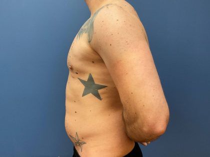 Liposuction Before & After