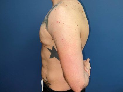 Liposuction Before & After