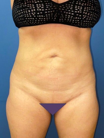 Liposuction Before & After