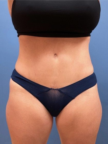 Liposuction Before & After