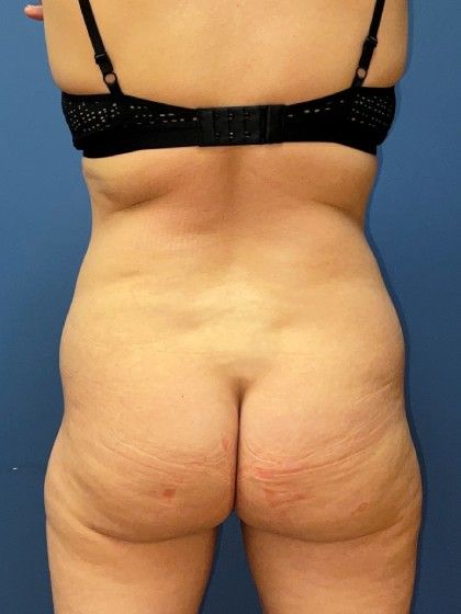 Liposuction Before & After