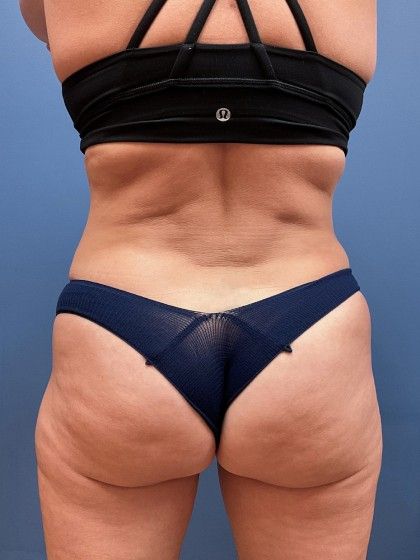 Liposuction Before & After