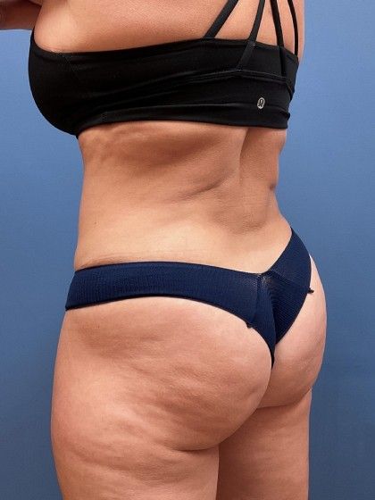 Liposuction Before & After