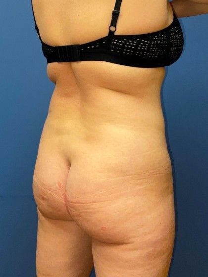 Liposuction Before & After