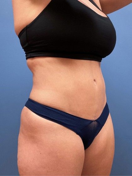 Liposuction Before & After