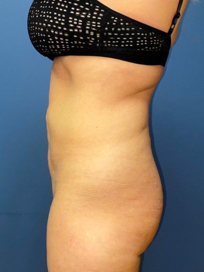 Liposuction Before & After
