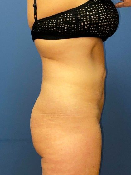 Liposuction Before & After