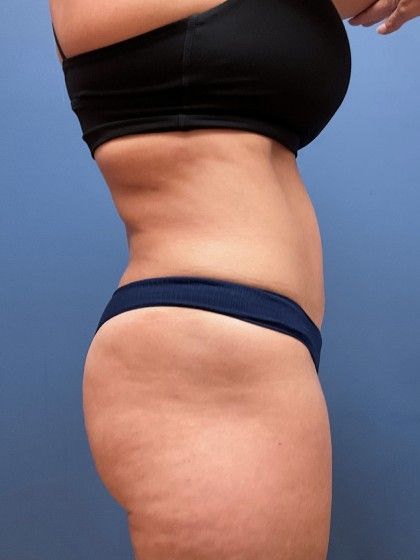 Liposuction Before & After