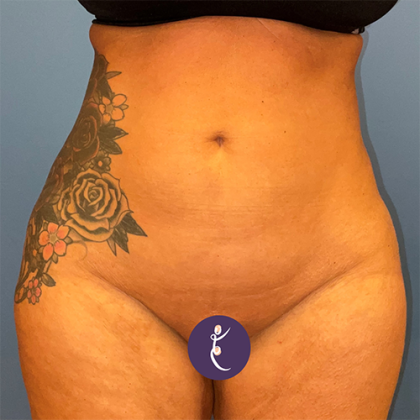 Liposuction Before & After