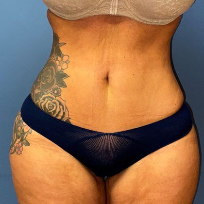 Liposuction Before & After