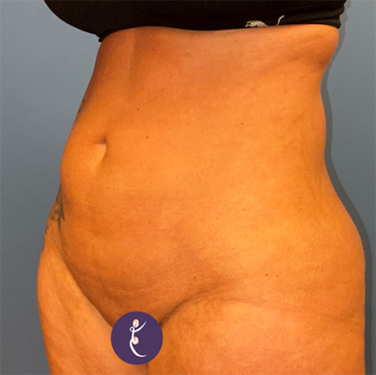 Liposuction Before & After