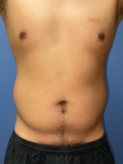 Liposuction Before & After