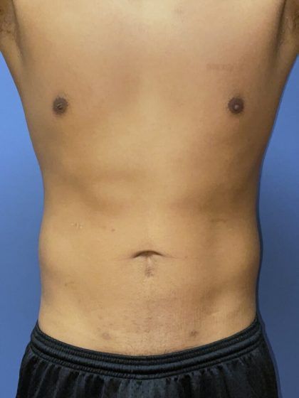 Liposuction Before & After