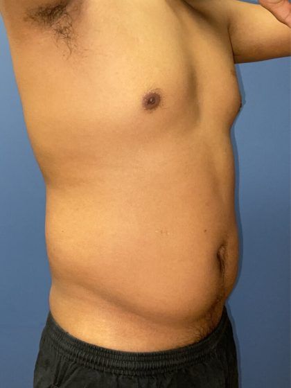 Liposuction Before & After
