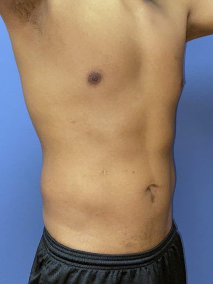 Liposuction Before & After