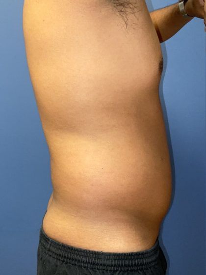 Liposuction Before & After