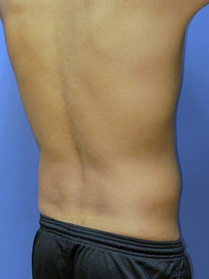 Liposuction Before & After