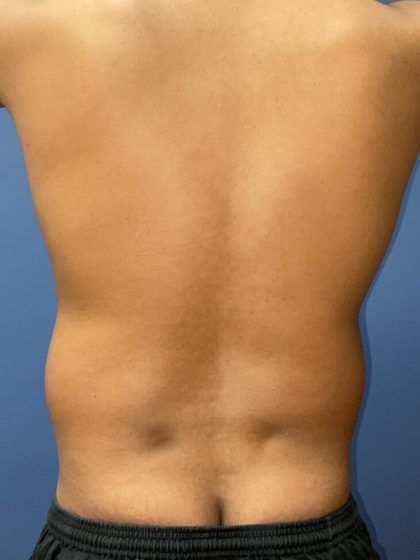 Liposuction Before & After