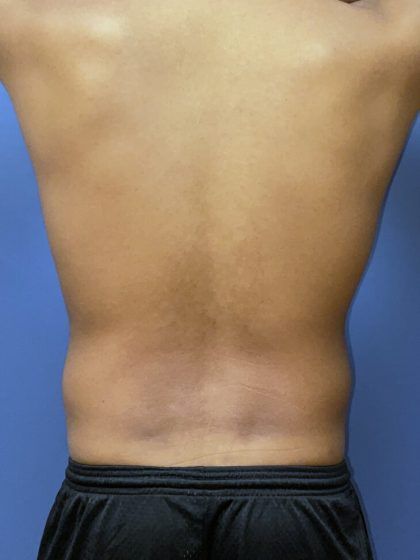 Liposuction Before & After