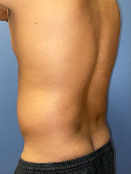 Liposuction Before & After