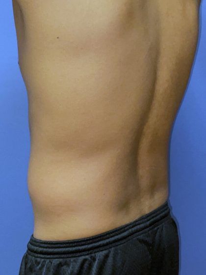 Liposuction Before & After