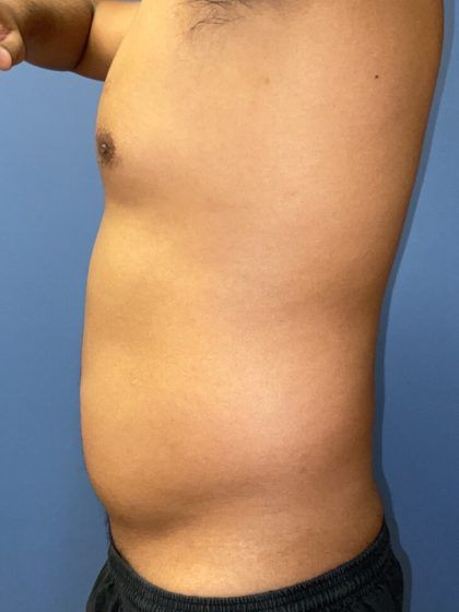 Liposuction Before & After