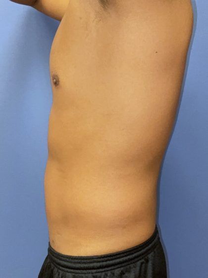 Liposuction Before & After