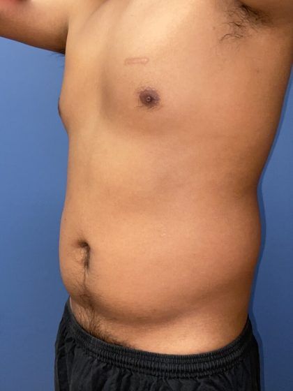 Liposuction Before & After