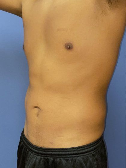 Liposuction Before & After