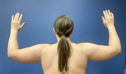 Liposuction Before & After