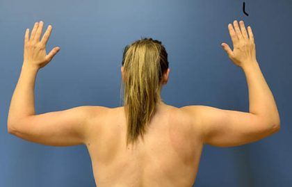 Liposuction Before & After