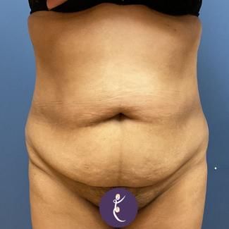 Liposuction Before & After