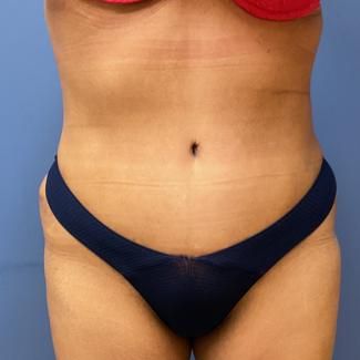 Liposuction Before & After
