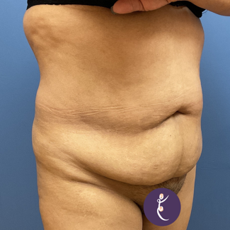 Liposuction Before & After