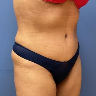 Liposuction Before & After