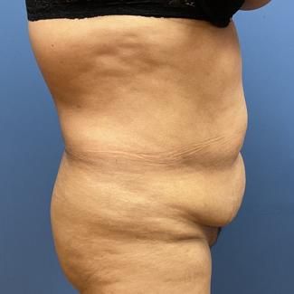 Liposuction Before & After