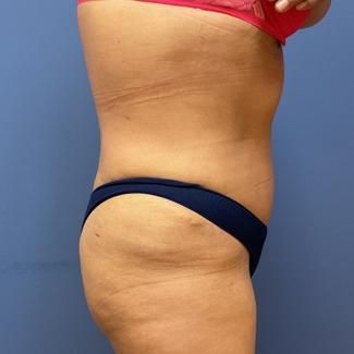 Liposuction Before & After