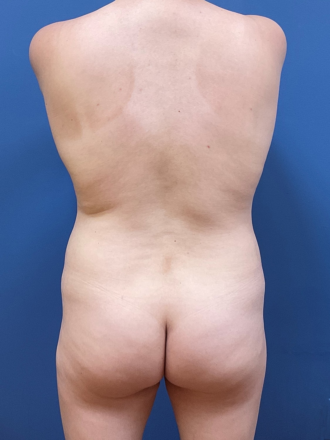 Liposuction Before & After