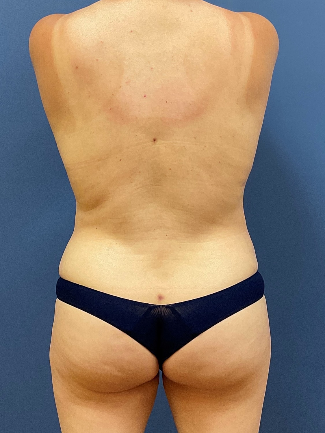 Liposuction Before & After